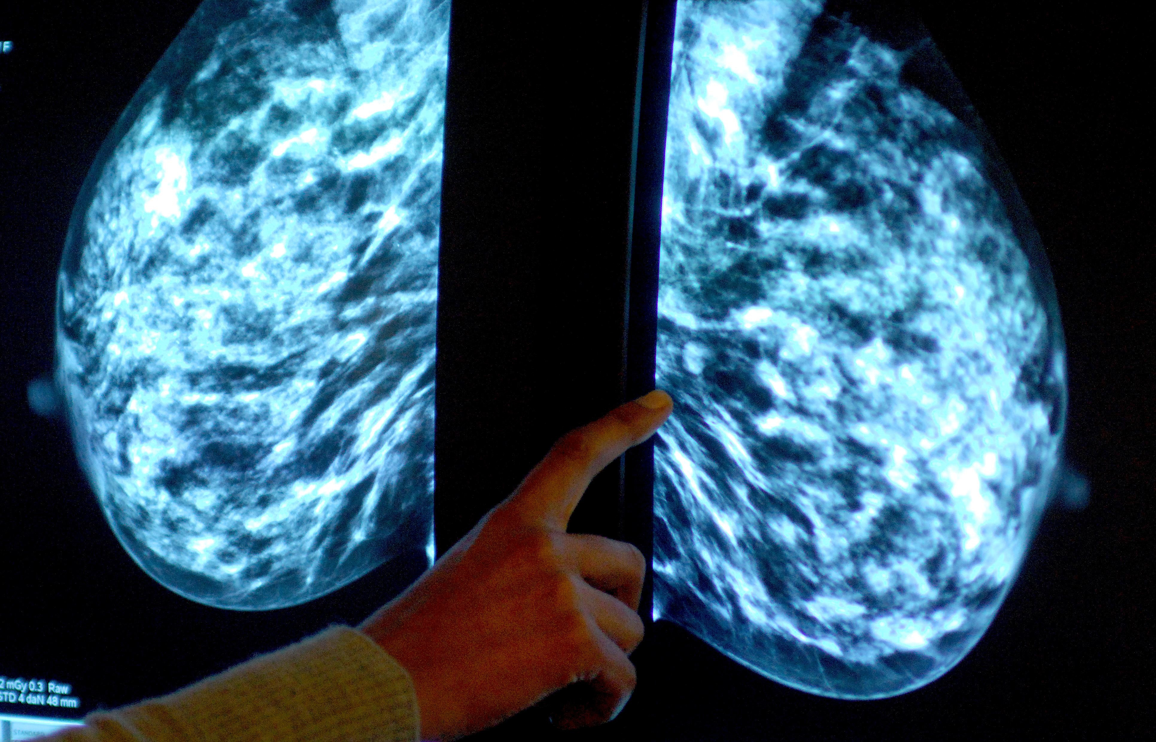 Breast screening uptake in Somerset remains below pre-pandemic levels