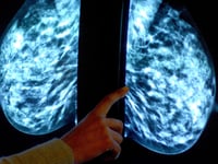 Breast screening uptake in Somerset remains below pre-pandemic levels