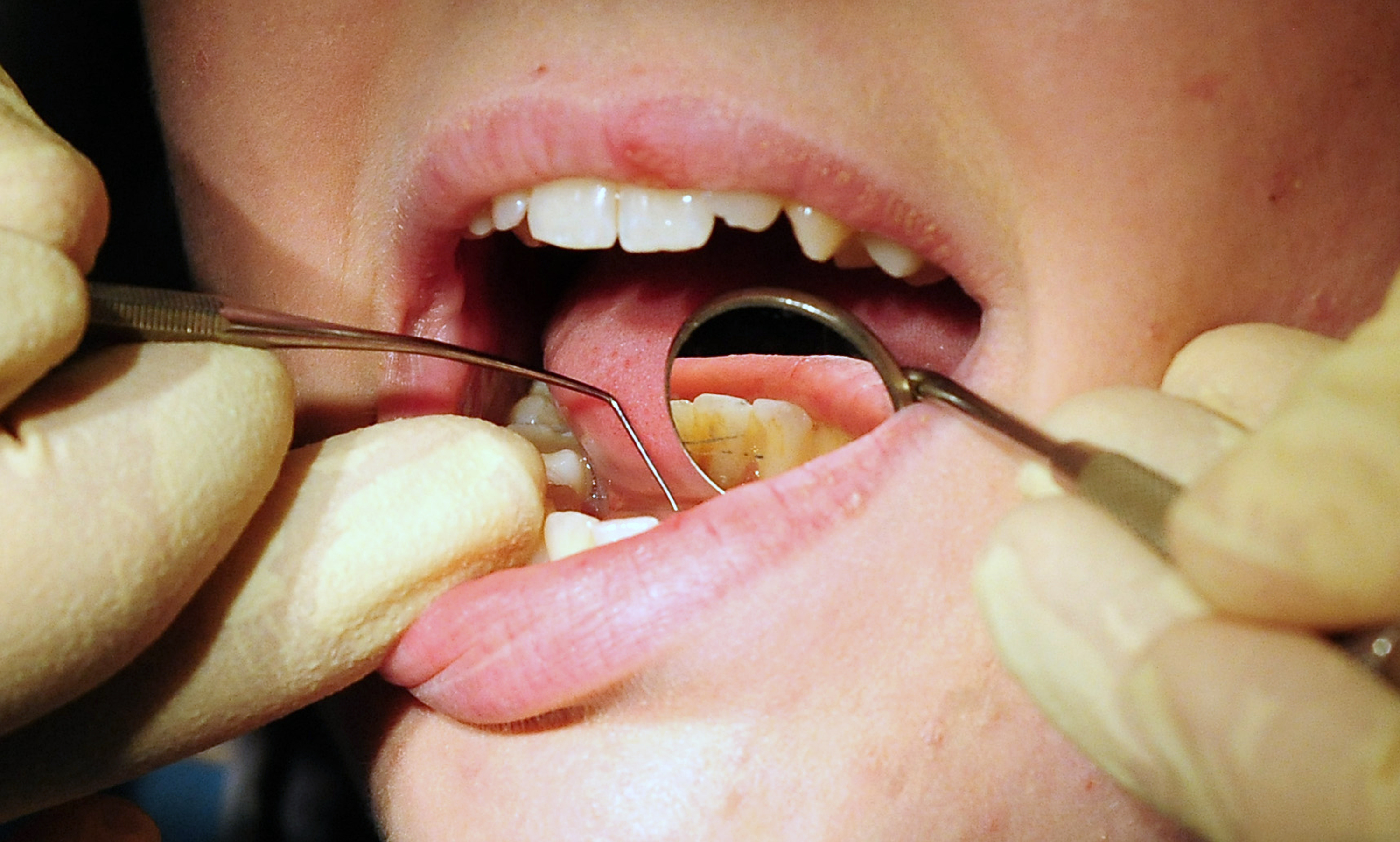 Half of people in Somerset struggle to get an NHS dentist appointment