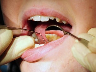 Half of people in Somerset struggle to get an NHS dentist appointment