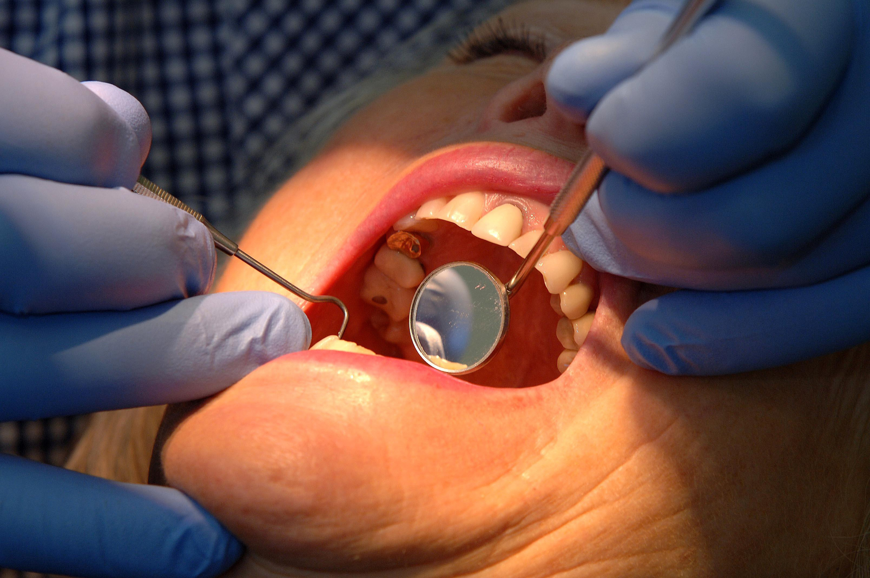  People in Somerset more likely to have access to an NHS dentist – as 'postcode lottery' sees thousands miss out