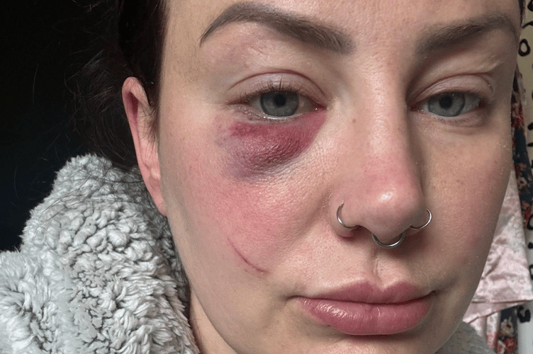 Chantz Crane suffered severe bruising following a surprise attack outside her barbershop on Fore Street